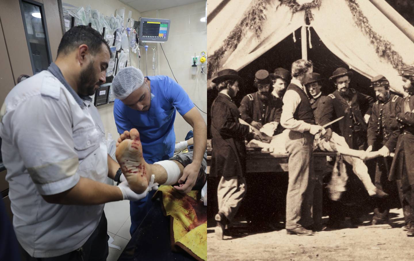 (L) Palestinian doctors work on a patient following the Israeli attack on Nuseirat Refugee Camp in Gaza on September 13, 2024. (R) Surgeons prepare to amputate a patient’s leg at Gettsyburg in 1863.